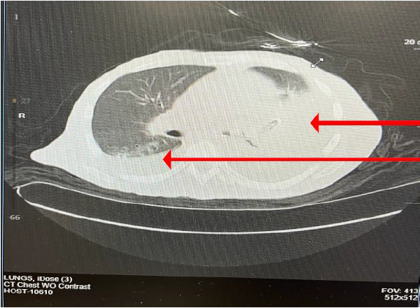 When Less is More: Palliative Decision-Making in a Bedbound Patient with Advanced Illness and Bilateral Pleural Effusions