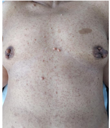 Neurofibromas of the Nipple-Areolar Complex: An Unusual Localization