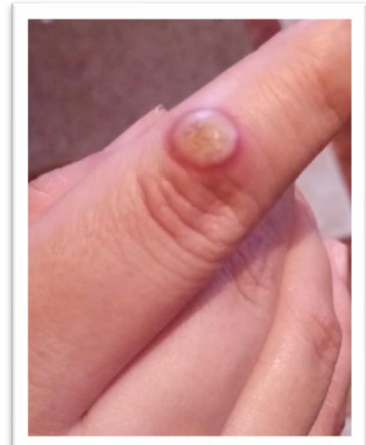 Human Orf Infection (Ecthyma Contagiosum) After Feast of Sacrifice