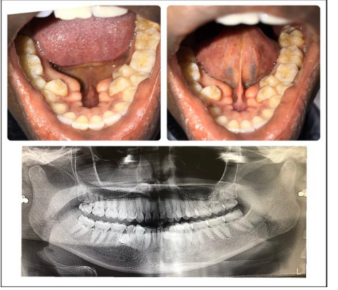 Torus Mandibularis with Supernumerary Teeth: A Unique Case