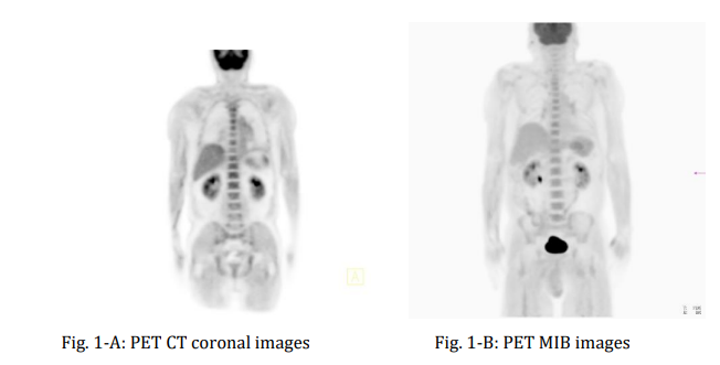 Atypical Case of Cold Agglutinins Disease (CAD), Hemophagocytic Lymphohistiocytosis (HLH), Narcolepsy, and Polymyalgia Rheumatica (PMR): Case Report & Management Discussion