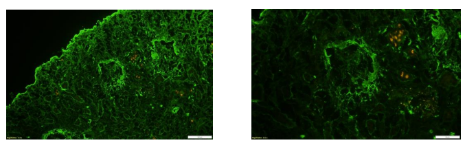 Isolated Glomerulonephritis as a Classic Presentation of Goodpasture Disease: A Case Report