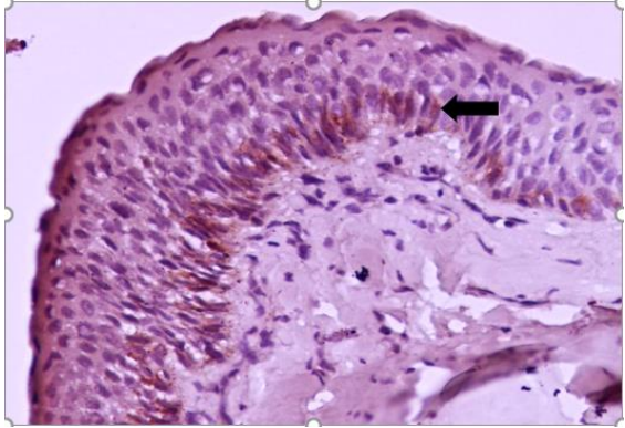 Immunohistochemical Comparison of CD10 Expression in Dentigerous Cyst, Odontogenic Keratocyst, and Unicystic Ameloblastoma
