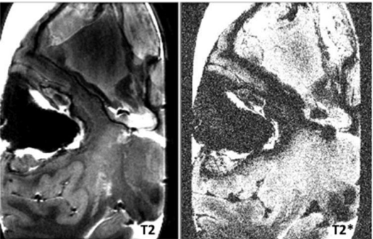 Lobar Intracerebral Haematomas: A Review