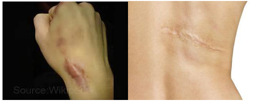 Sexual Dimorphism and Other Etiological Factors for Keloids