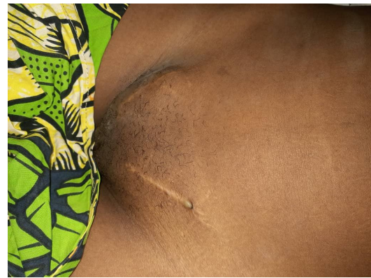 Klinefelter Syndrome in an Identical Twin: A Case Report and Review of Literature