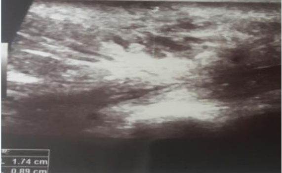 A Rare Case of a Recidiving Radio-Induced Breast Angiosarcome